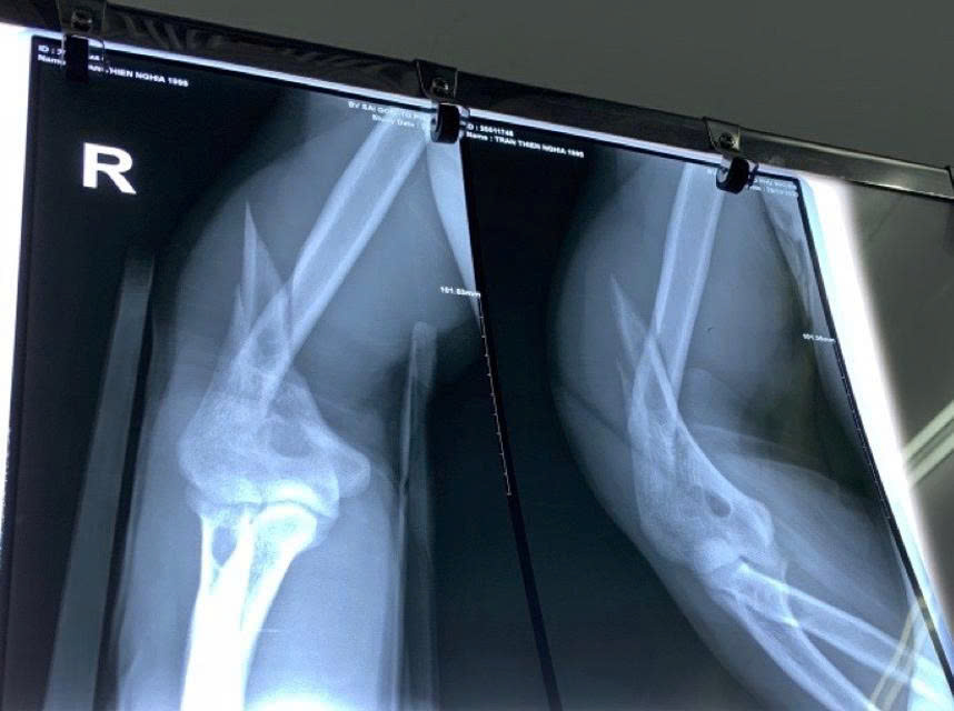 Nguy cơ gãy xương từ trò vật tay