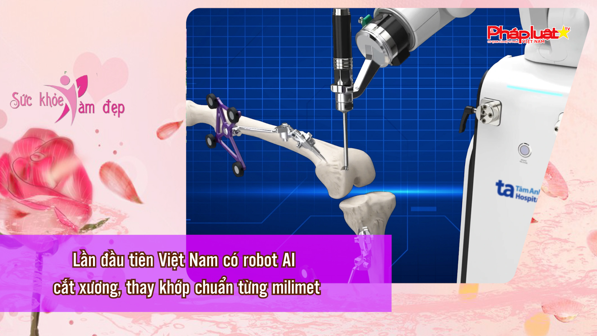 Bản tin Sức khỏe và Làm đẹp (ngày 12/4/2026): Lần đầu tiên Việt Nam có robot AI cắt xương, thay khớp chuẩn từng milimet