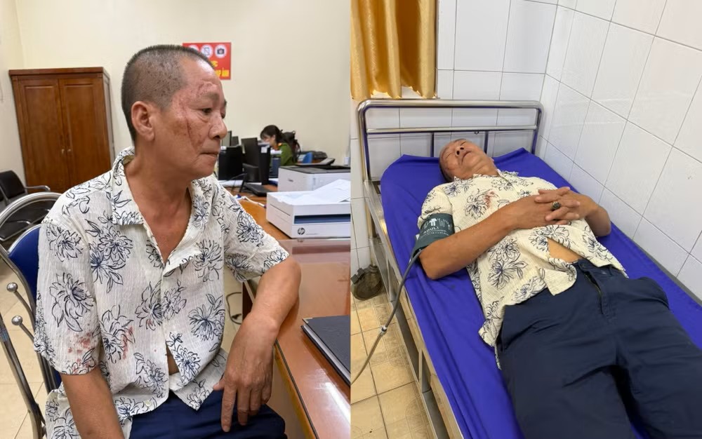 Một người đàn ông vô cớ bị đánh, phải nhập viện